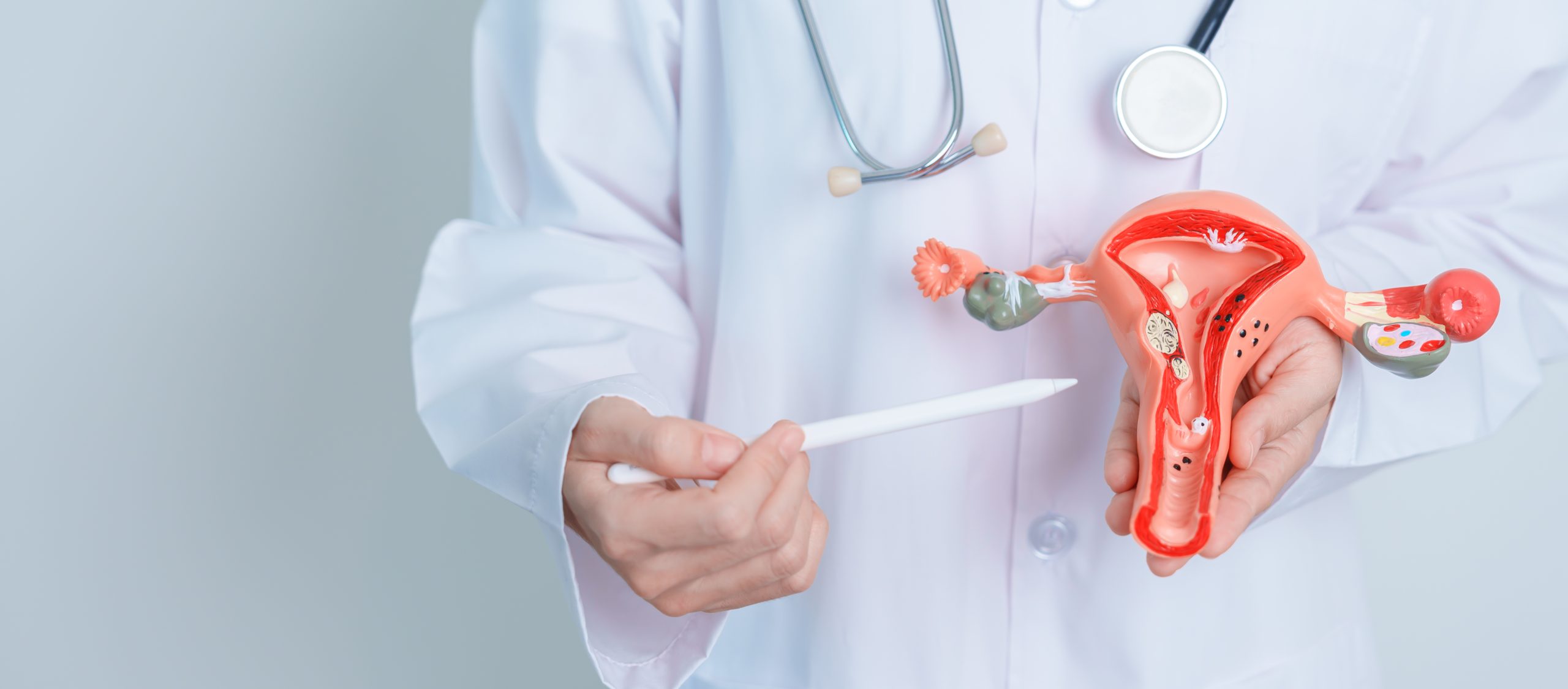 Cancer des ovaires avancé