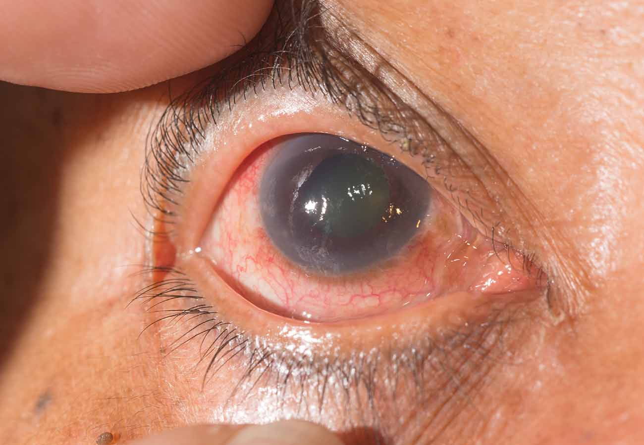 El glaucoma no se cura, se detiene su evolución patológica